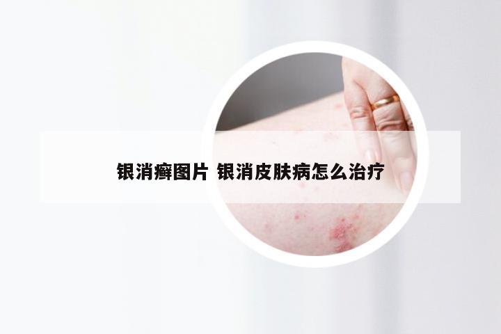 银消癣图片 银消皮肤病怎么治疗