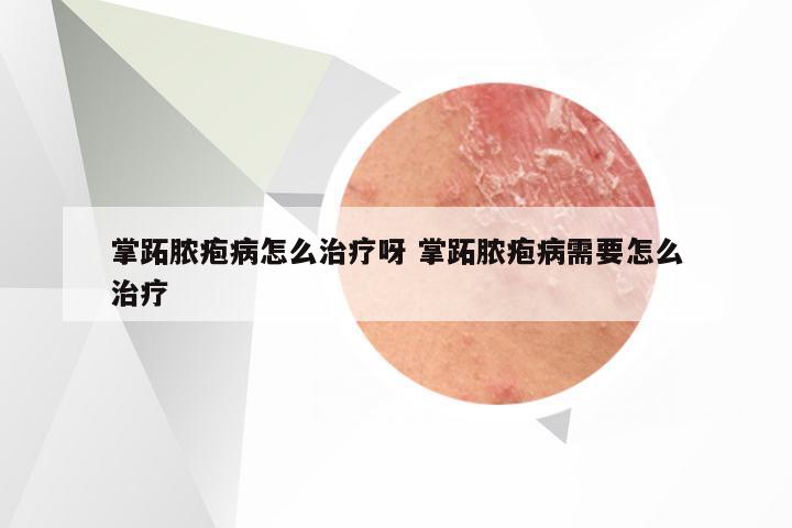 掌跖脓疱病怎么治疗呀 掌跖脓疱病需要怎么治疗