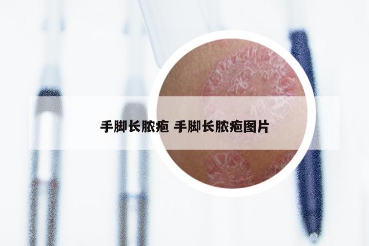 手脚长脓疱 手脚长脓疱图片