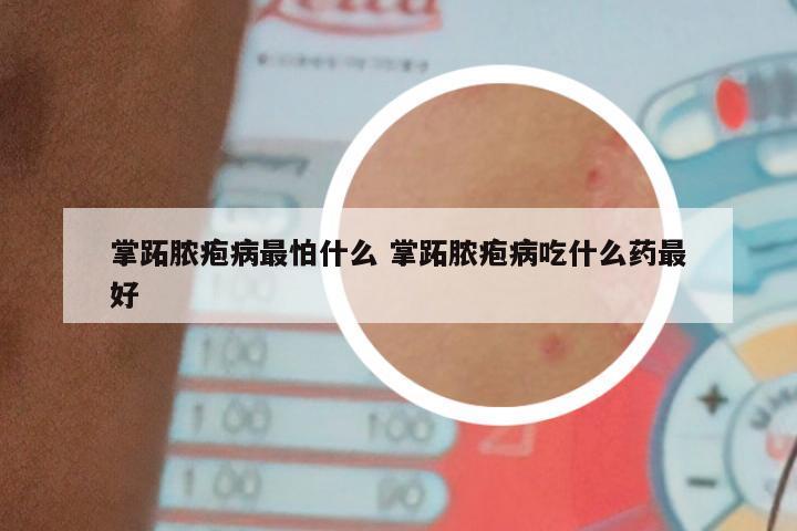 掌跖脓疱病最怕什么 掌跖脓疱病吃什么药最好