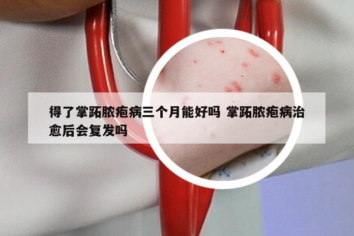 得了掌跖脓疱病三个月能好吗 掌跖脓疱病治愈后会复发吗