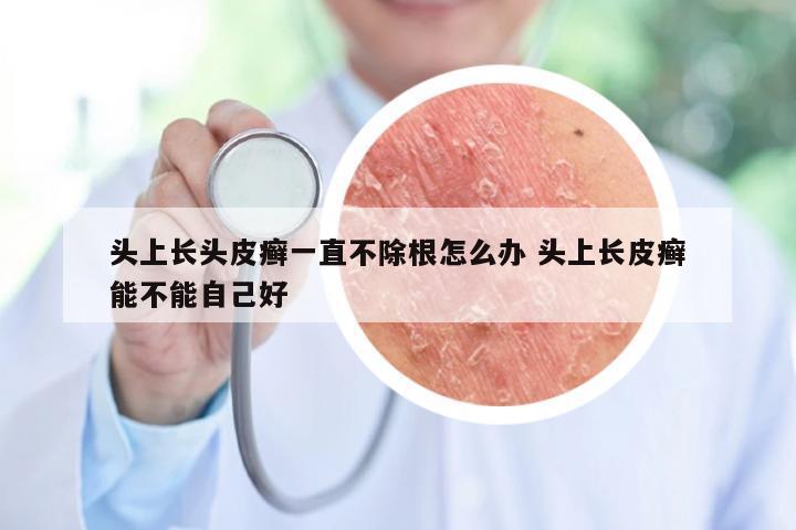 头上长头皮癣一直不除根怎么办 头上长皮癣能不能自己好