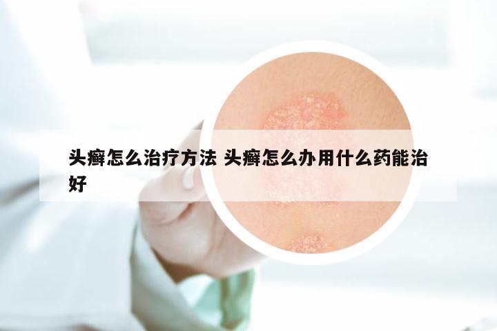 头癣怎么治疗方法 头癣怎么办用什么药能治好
