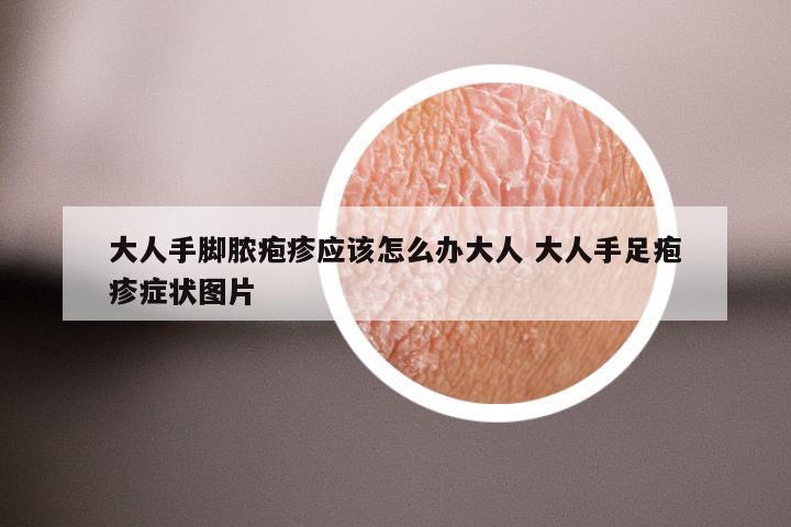 大人手脚脓疱疹应该怎么办大人 大人手足疱疹症状图片