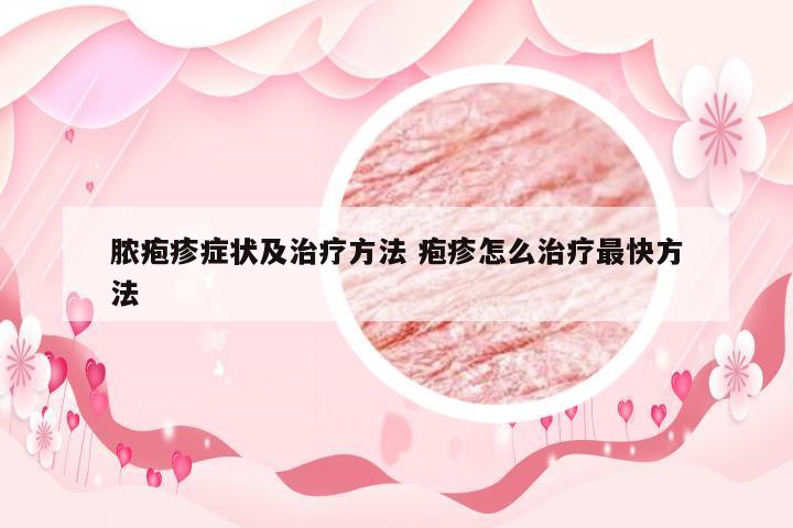脓疱疹症状及治疗方法 疱疹怎么治疗最快方法