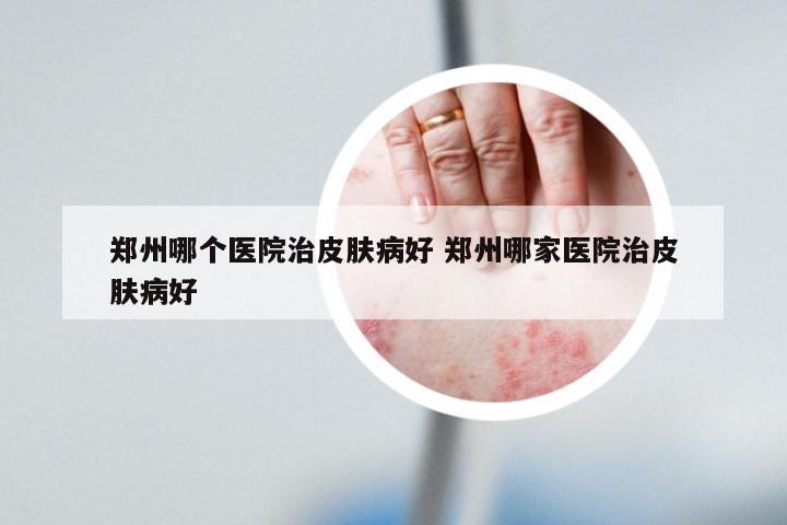 郑州哪个医院治皮肤病好 郑州哪家医院治皮肤病好
