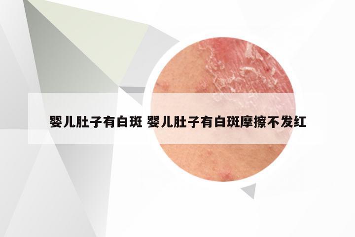 婴儿肚子有白斑 婴儿肚子有白斑摩擦不发红