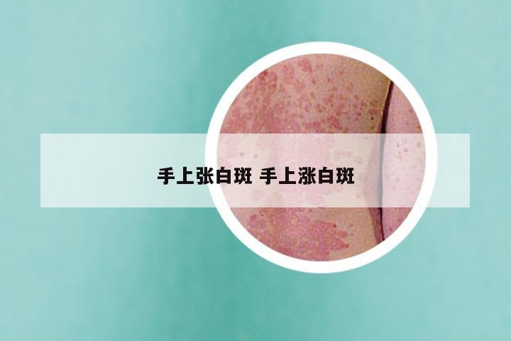 手上张白斑 手上涨白斑