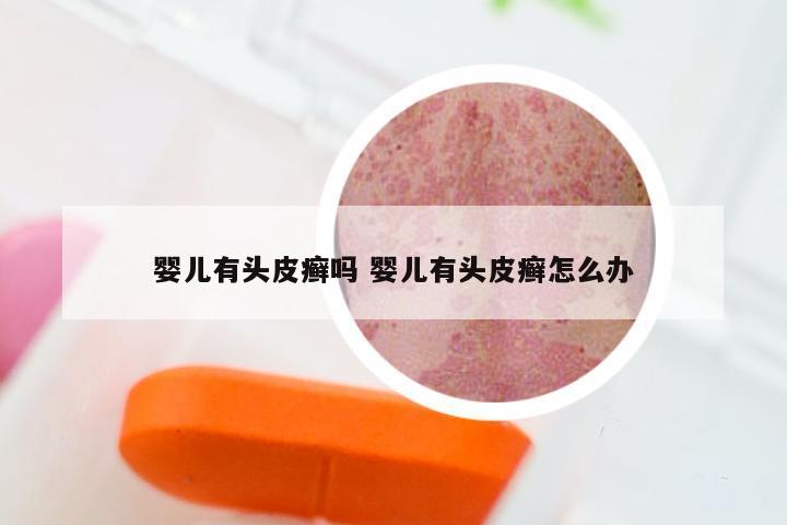 婴儿有头皮癣吗 婴儿有头皮癣怎么办