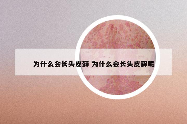 为什么会长头皮藓 为什么会长头皮藓呢