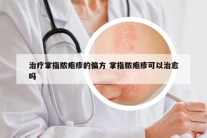 治疗掌指脓疱疹的偏方 掌指脓疱疹可以治愈吗