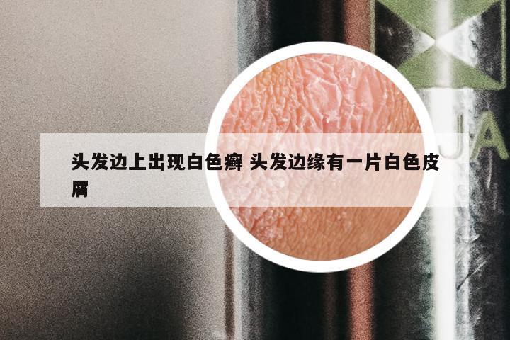 头发边上出现白色癣 头发边缘有一片白色皮屑