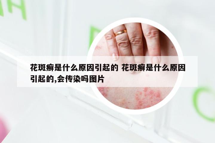 花斑癣是什么原因引起的 花斑癣是什么原因引起的,会传染吗图片