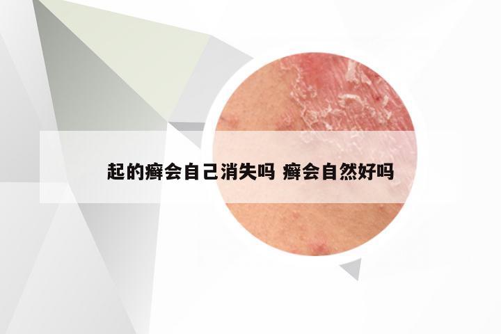 起的癣会自己消失吗 癣会自然好吗