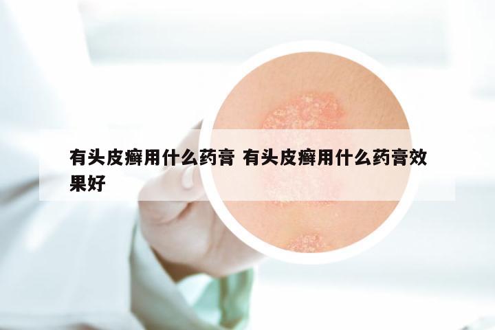 有头皮癣用什么药膏 有头皮癣用什么药膏效果好
