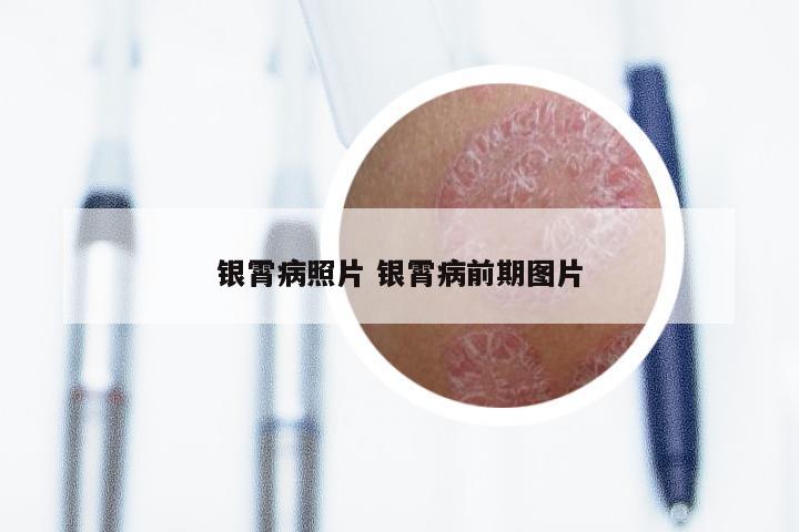 银霄病照片 银霄病前期图片