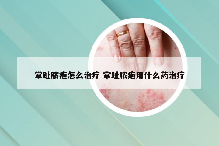 掌趾脓疱怎么治疗 掌趾脓疱用什么药治疗