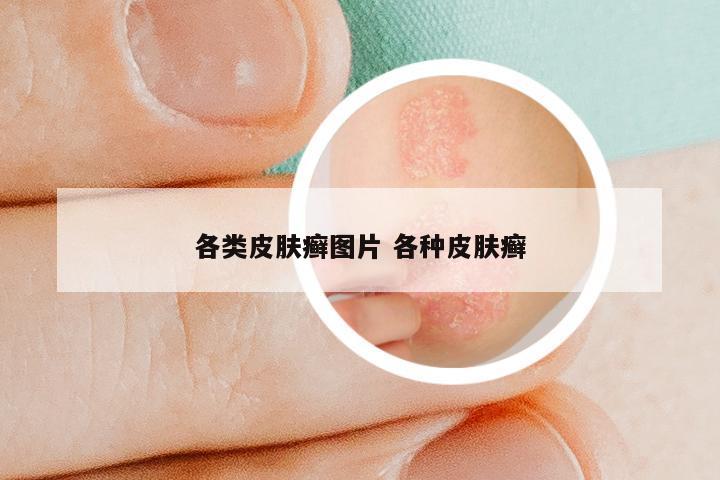 各类皮肤癣图片 各种皮肤癣