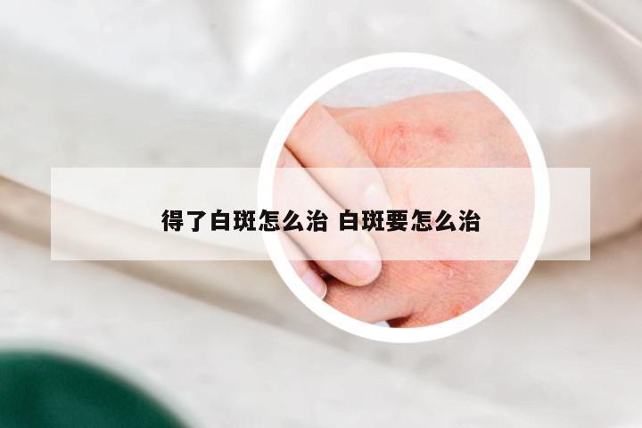 得了白斑怎么治 白斑要怎么治