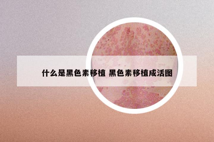 什么是黑色素移植 黑色素移植成活图