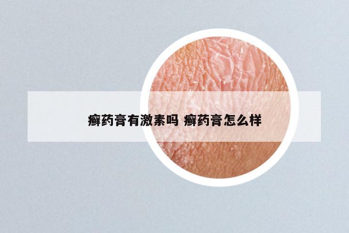 癣药膏有激素吗 癣药膏怎么样