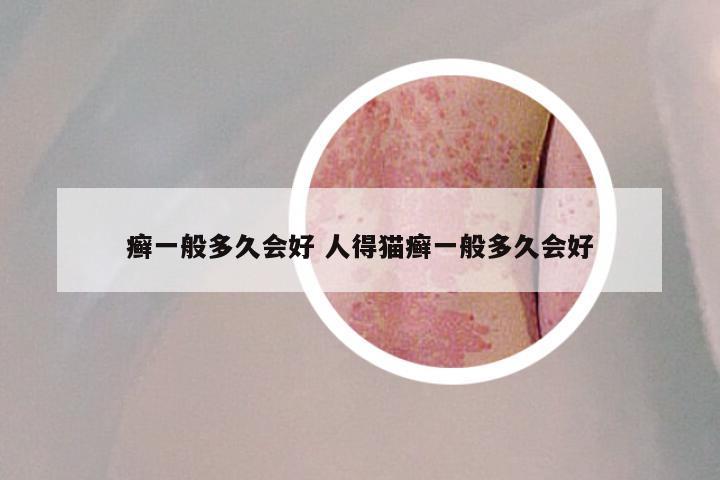 癣一般多久会好 人得猫癣一般多久会好