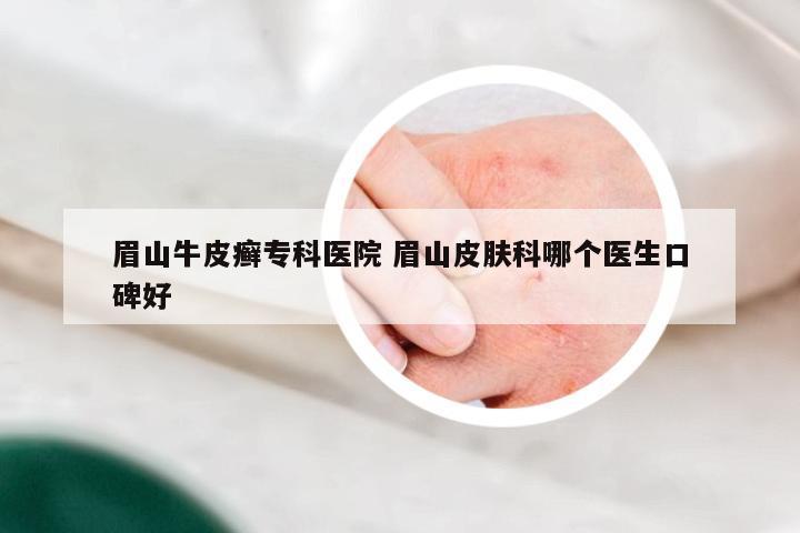 眉山牛皮癣专科医院 眉山皮肤科哪个医生口碑好