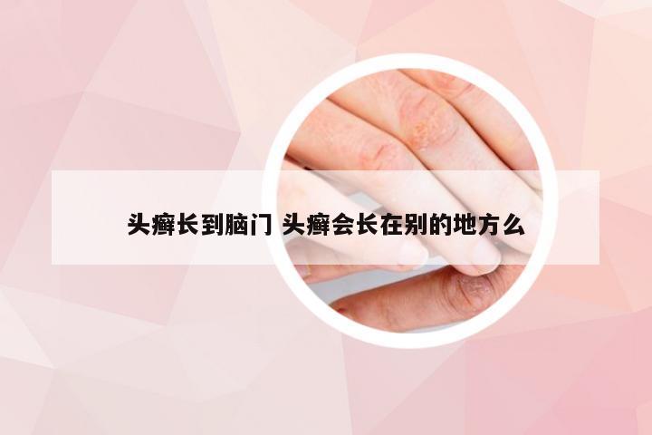 头癣长到脑门 头癣会长在别的地方么