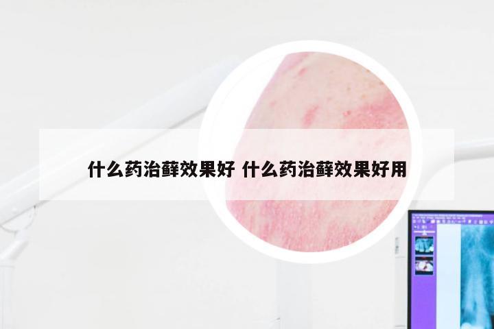 什么药治藓效果好 什么药治藓效果好用