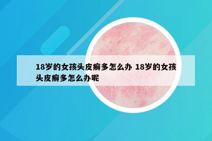 18岁的女孩头皮癣多怎么办 18岁的女孩头皮癣多怎么办呢