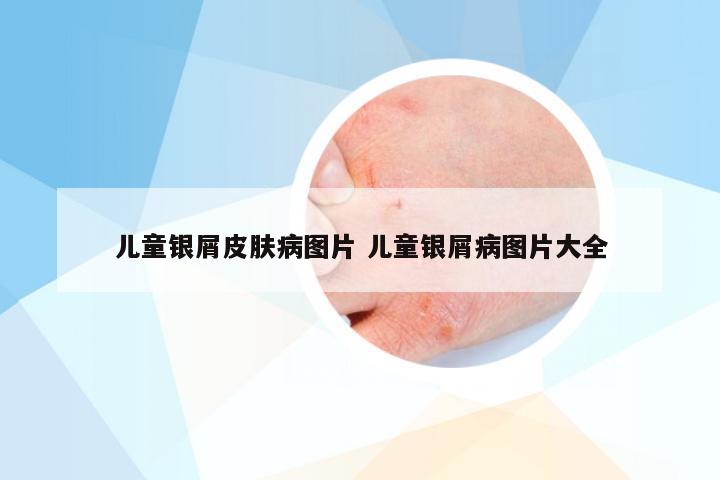 儿童银屑皮肤病图片 儿童银屑病图片大全