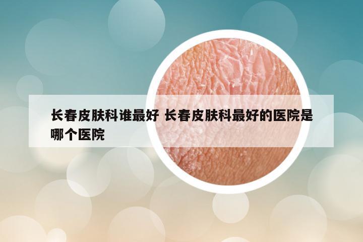 长春皮肤科谁最好 长春皮肤科最好的医院是哪个医院