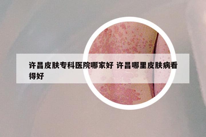 许昌皮肤专科医院哪家好 许昌哪里皮肤病看得好