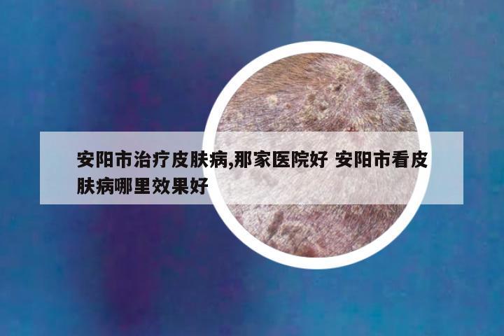 安阳市治疗皮肤病,那家医院好 安阳市看皮肤病哪里效果好