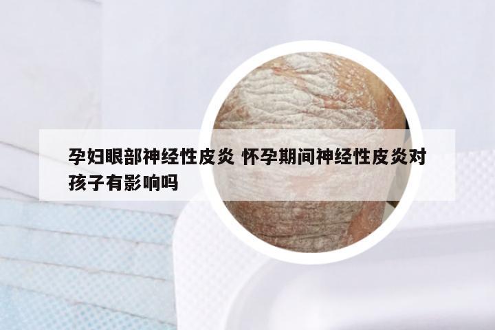 孕妇眼部神经性皮炎 怀孕期间神经性皮炎对孩子有影响吗