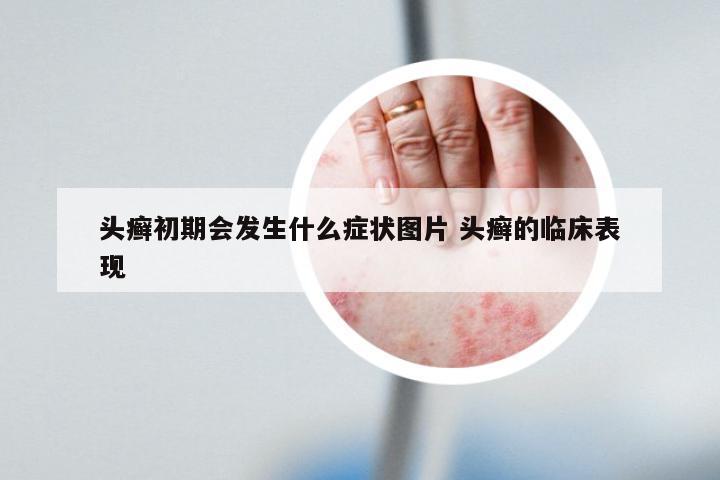 头癣初期会发生什么症状图片 头癣的临床表现