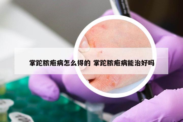 掌跎脓疱病怎么得的 掌跎脓疱病能治好吗