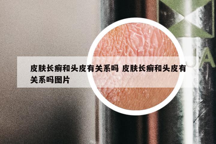 皮肤长癣和头皮有关系吗 皮肤长癣和头皮有关系吗图片