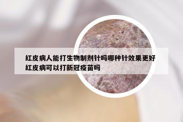 红皮病人能打生物制剂针吗哪种针效果更好 红皮病可以打新冠疫苗吗