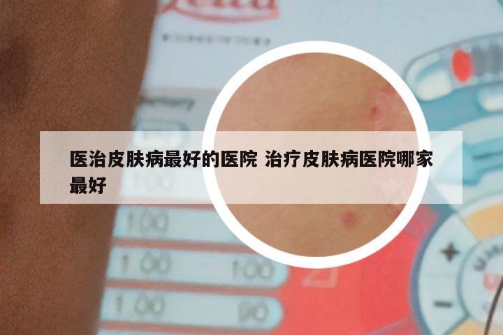 医治皮肤病最好的医院 治疗皮肤病医院哪家最好