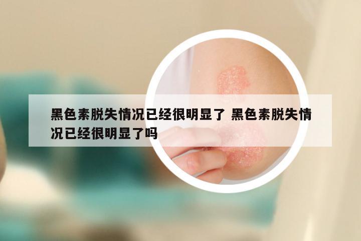 黑色素脱失情况已经很明显了 黑色素脱失情况已经很明显了吗
