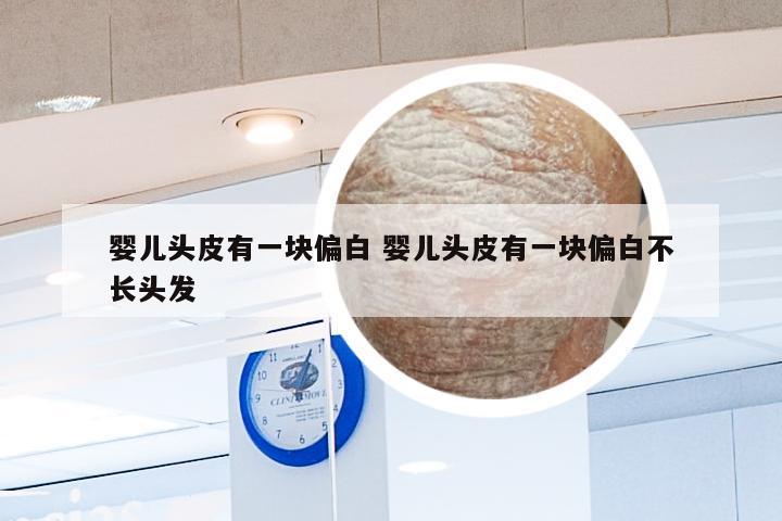 婴儿头皮有一块偏白 婴儿头皮有一块偏白不长头发