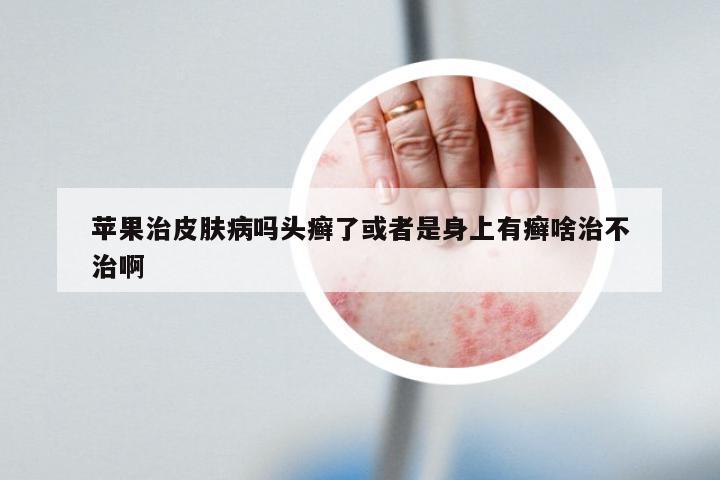 苹果治皮肤病吗头癣了或者是身上有癣啥治不治啊