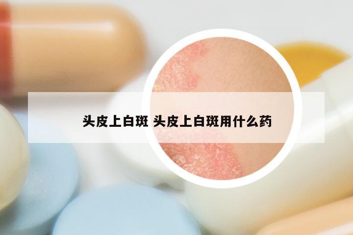 头皮上白斑 头皮上白斑用什么药