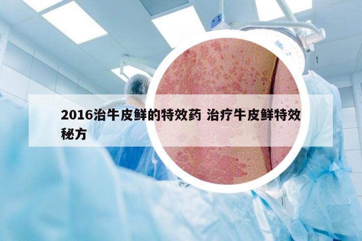 2016治牛皮鲜的特效药 治疗牛皮鲜特效秘方