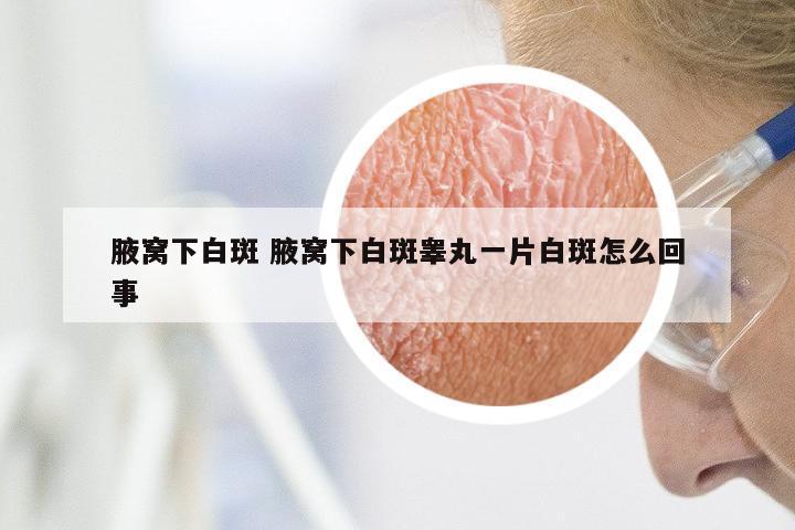腋窝下白斑 腋窝下白斑睾丸一片白斑怎么回事