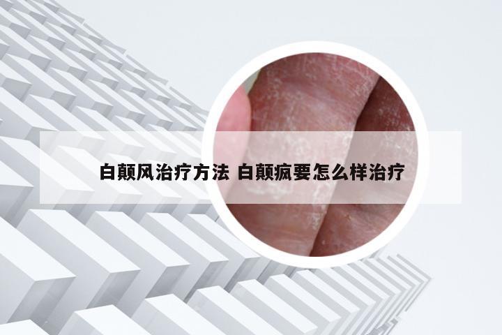 白颠风治疗方法 白颠疯要怎么样治疗