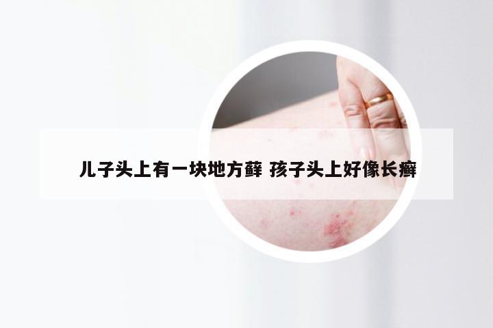 儿子头上有一块地方藓 孩子头上好像长癣