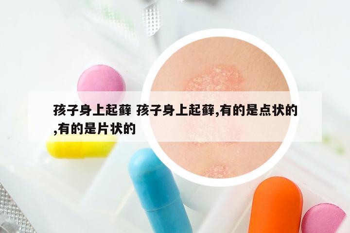 孩子身上起藓 孩子身上起藓,有的是点状的,有的是片状的