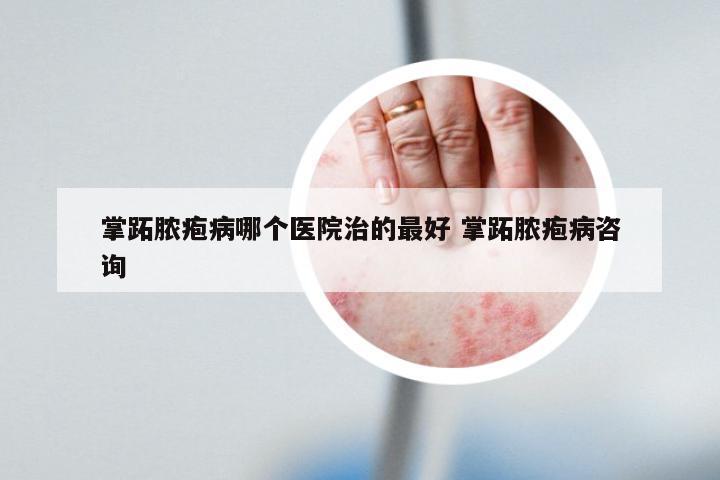 掌跖脓疱病哪个医院治的最好 掌跖脓疱病咨询